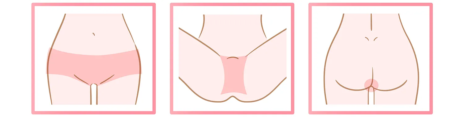 静岡市の医療脱毛でVIO全部位　※女性限定