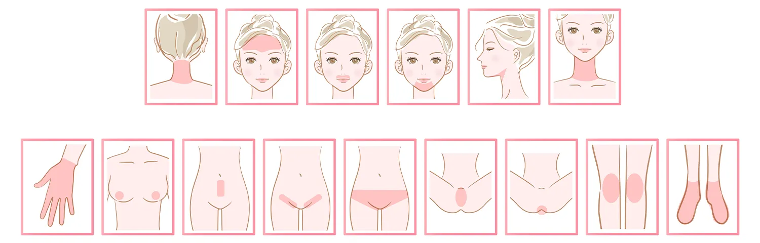 静岡市の医療脱毛でSパーツ